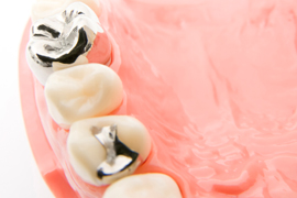 銀歯の“虫歯スパイラル”