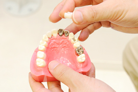 セラミックが起こした虫歯治療革命
