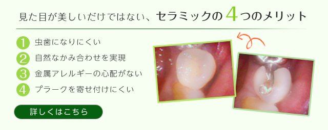 見た目が美しいだけではない、セラミックのメリット